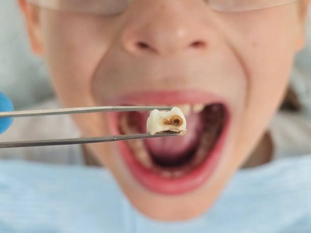 Best Emergency Tooth Extraction in Live Oak, FL